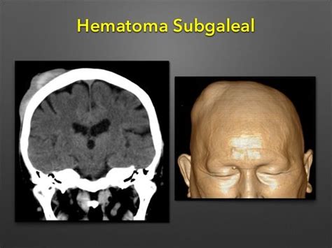 hematoma subgaleal - hematoma en el embarazo
